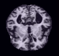 MRI image