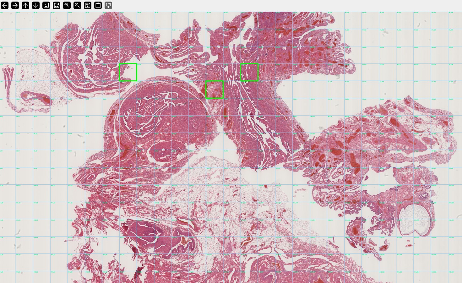 Illustration of AI in cancer diagnostics